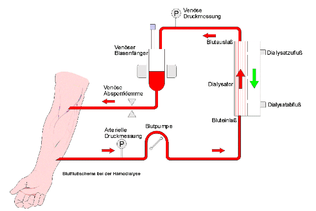 Schema der H�modialyse
